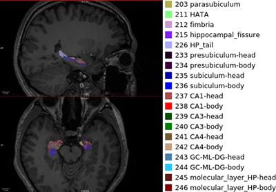 Hippocampal subfield morphology from first episodes of bipolar disorder type II and major depressive disorder in a drug naïve Chinese cohort